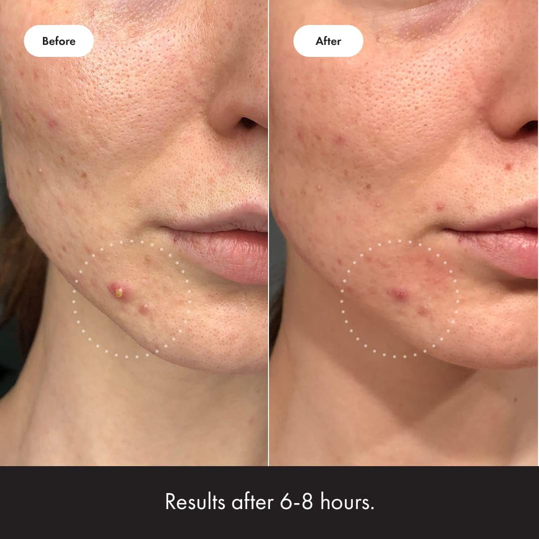 Hero Cosmetics ™ Invisible+ Patch & ™ Surface Patch Bundle - Acne Patches for Daytime and Larger Breakout Treatment of Pimples