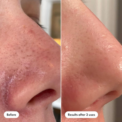 Nose Patch and Pore Release from Hero Cosmetics